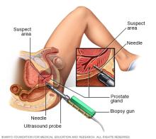Prostate transrectal biopsy 