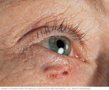 Basal cell carcinoma on white skin