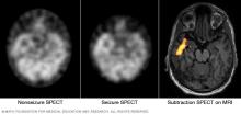 SPECT scan