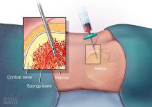A needle suctioning out liquid bone marrow from hipbone