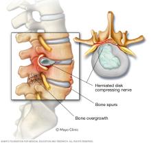 Illustration showing bone spurs and herniated disk in the spine