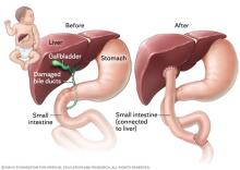 A baby's anatomy before and after the Kasai procedure