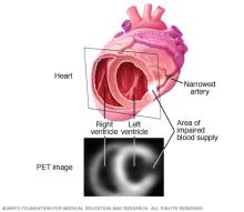 Cardiac PET scan