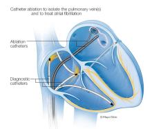 Location of catheters for for pulmonary vein isolation