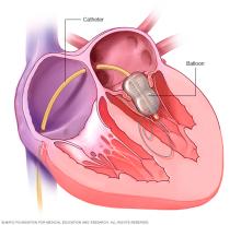 Balloon valvuloplasty