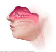 Illustration of nasal polyps in the nose and sinuses