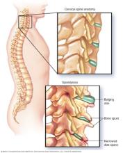 : Illustration showing cervical spondylosis