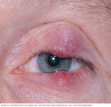 Photograph showing a chalazion