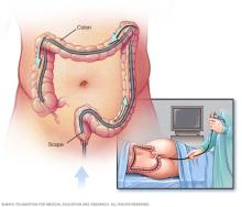 Illustration of colonoscopy exam