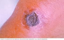 An A large sore with a black center, caused by cutaneous anthrax