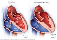 Illustration showing left ventricular hypertrophy.