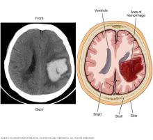 Intracerebral hemorrhage
