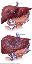 Typical liver blood flow versus portal hypertension