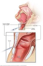 Botox injections in the neck