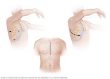 Illustrations of incisions in minimally invasive and open-heart surgery