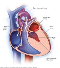 Illustration showing hypoplastic left heart syndrome