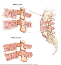 Healthy bone and weakened bone