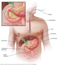Illustration of a scope passing through the esophagus to place a catheter into the bile duct near the pancreas