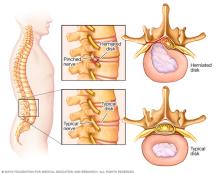 Pinched nerve in spine