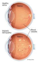 Illustration showing severe nonproliferative diabetic retinopathy