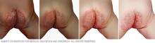 Diaper rash often appears on the buttocks, thighs and genitals.