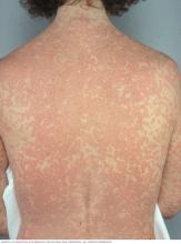 Image of rash caused by drug allergy