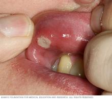 White canker sore on inside of upper lip.
