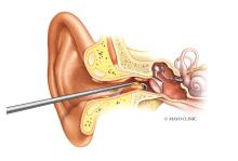 Earwax removal by a health care provider
