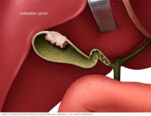 Gallbladder cancer