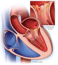Effects of endocarditis on the heart