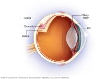 Illustration of the uvea where uveitis occurs