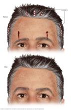Brow lift