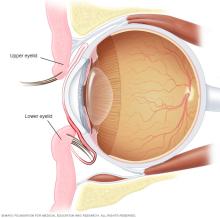 Illustration showing entropion