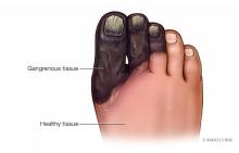 Gangrene of the foot