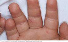 Photo of rash on the hand caused by hand-foot-and-mouth disease