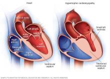 Typical heart and heart with hypertrophic cardiomyopathy
