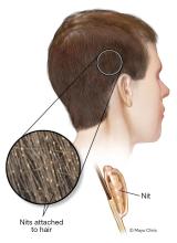 Illustration showing nits on hair
