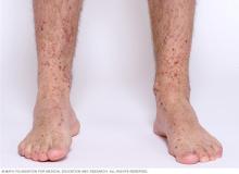 Image showing Henoch-Schonlein purpura