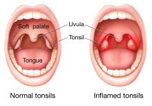 Inflamed tonsils