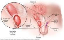 Illustration showing inguinal hernia