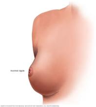 Illustration of an inverted nipple