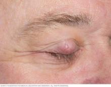 Sebaceous carcinoma on the eyelid