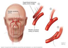 Direct revascularization procedure for moyamoya disease