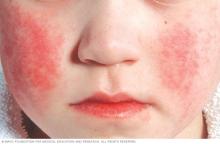 Face rash of parvovirus infection