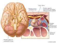 Prolactinoma in the pituitary gland