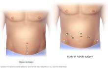 Location of incisions for open prostatectomy compared with incisions for robotic prostatectomy
