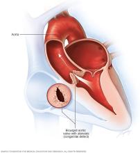 Bicuspid aortic valve with stenosis
