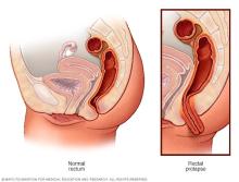 Illustration showing typical rectum and rectal prolapse 