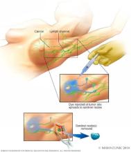 Sentinel node biopsy
