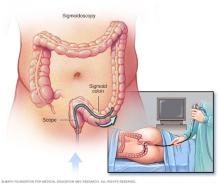 Illustration of flexible sigmoidoscopy exam